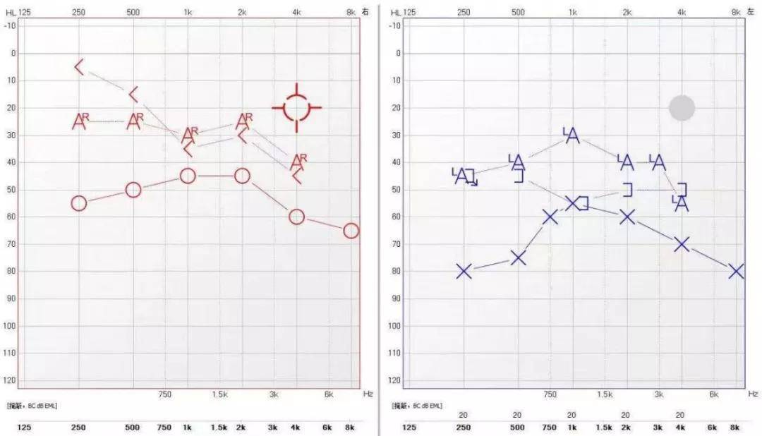 耳硬化症纯音测听图图片