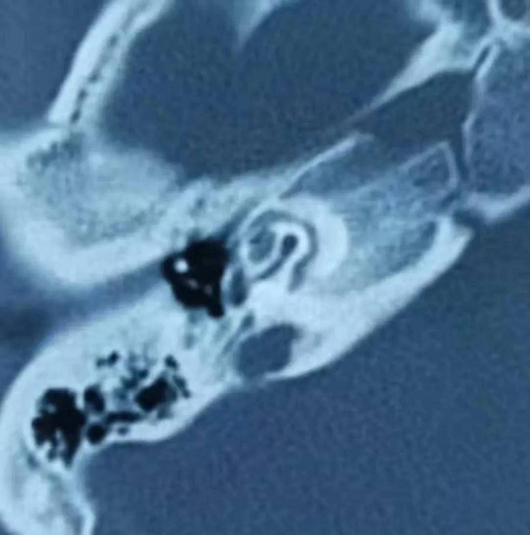 t可见耳蜗周围低密度环绕“双轨征”，符合严重的耳硬化耳蜗型影像表现。