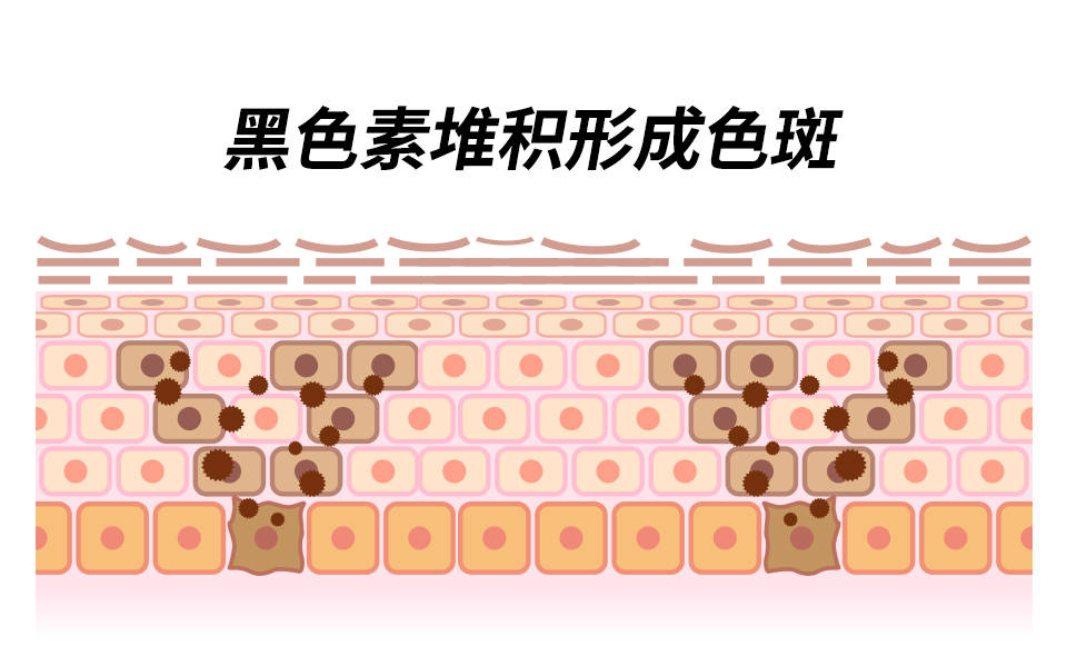 日晒,熬夜,精神压力大等因素导致,呈现对称分布,是片状黄褐色或褐色斑