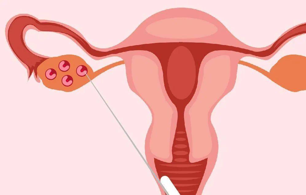 26岁女性卵巢储备不足，促排怀孕的成功率高不高？