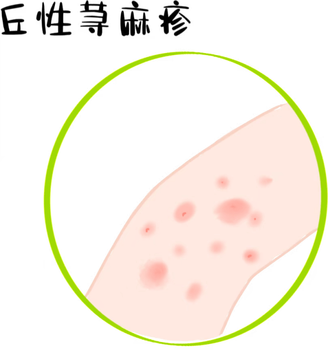 6 蜱虫叮咬包蜱虫叮咬后轻症患者一般会出现红斑瘙痒的情况