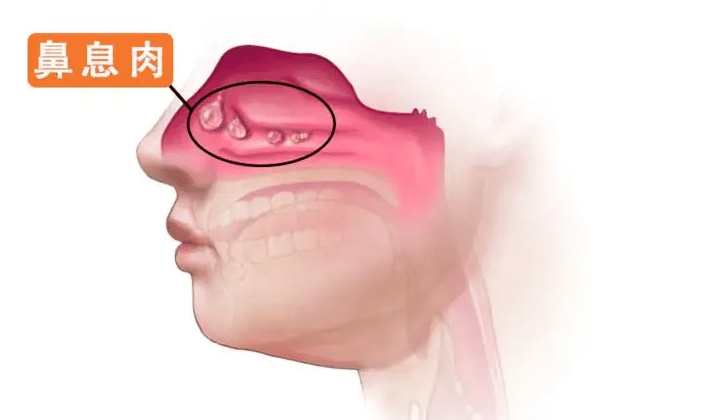 出現這些症狀你得小心鼻息肉
