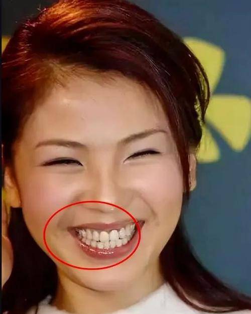 整个手术后,刘涛的牙齿非常白,她脸上最突出的部分是她的牙齿