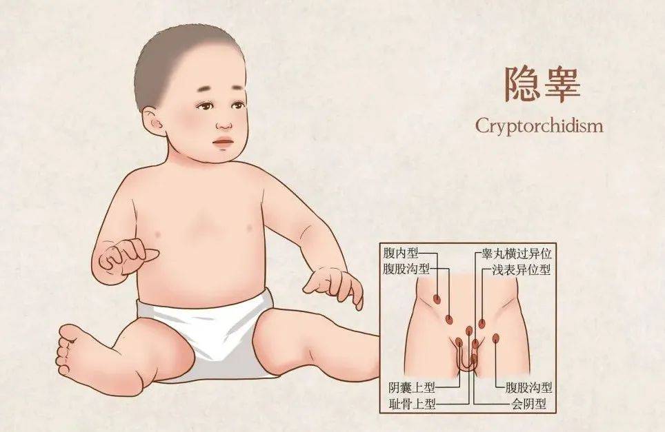 隐睾,是指男婴出生后单边或双边睾丸未降至阴囊而停留在其正常下降