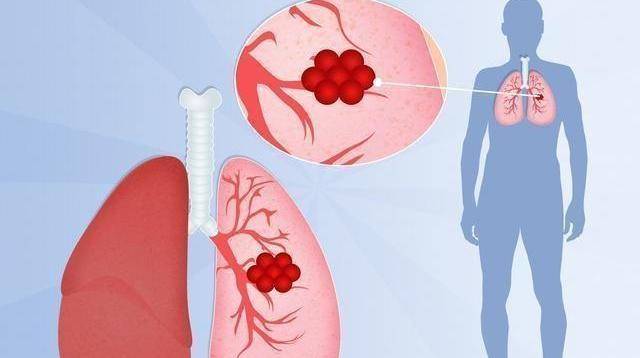 原創肺癌多是拖出來的提醒身上若有2痛1凸建議查下肺ct