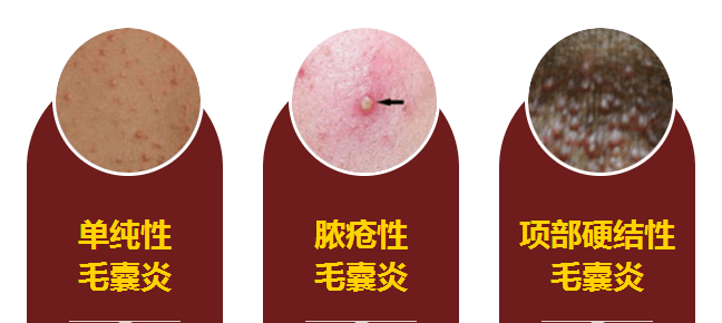 夏天皮肤毛囊出现红肿、疼痛、瘙痒是咋回事?_疙瘩_丘疹_症状