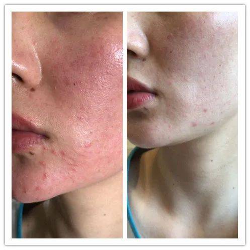 怎么按摩脸部促进血液循环去红血丝?收藏备用!_皮肤_激素_才是真