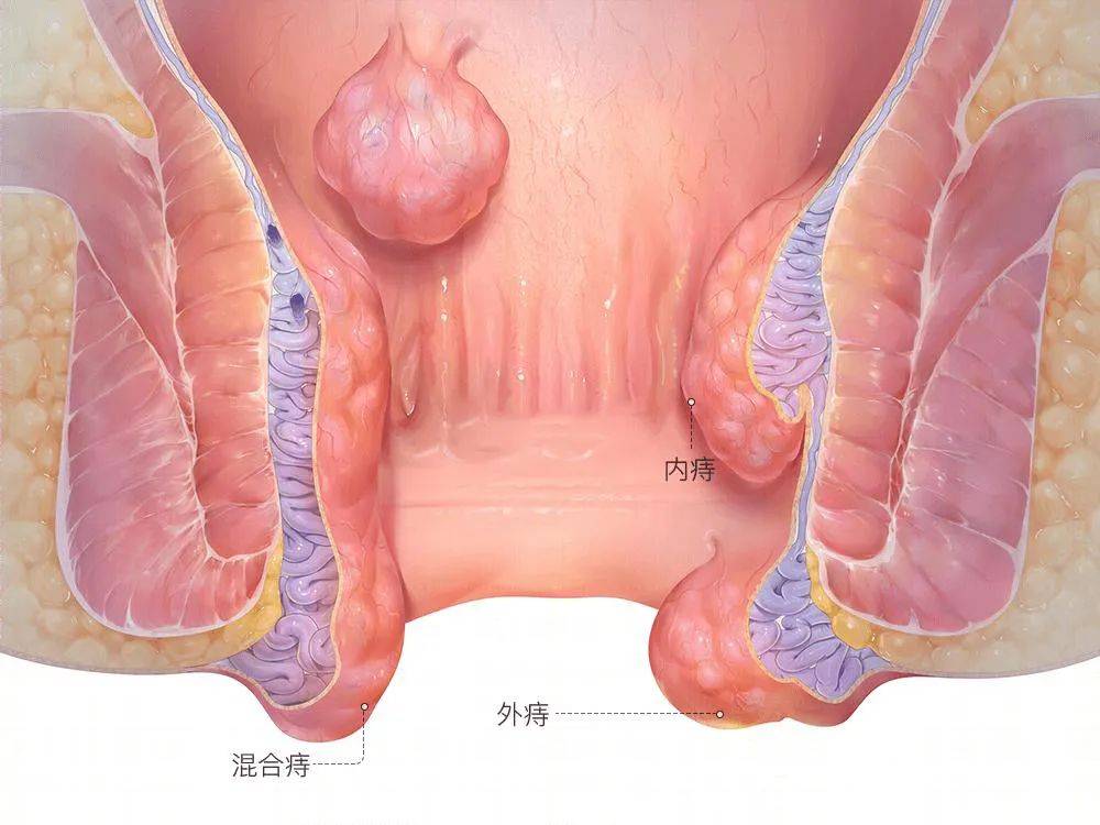 西安馬應龍肛腸醫院痔瘡的日常防護注意事項