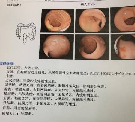 肠息肉容易癌变的图片图片