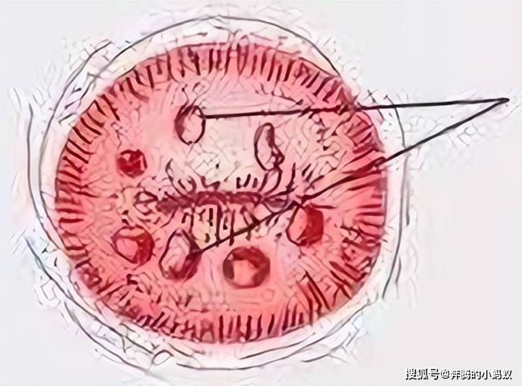 宫颈腺体囊肿图片大全图片