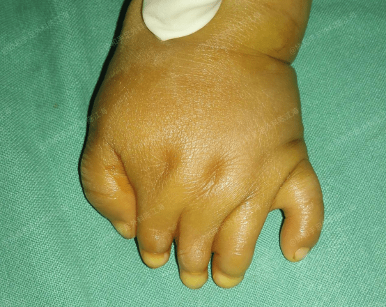 并指免植皮|案例6 孩子波兰综合征并指,手术做的早,术后外形和功能