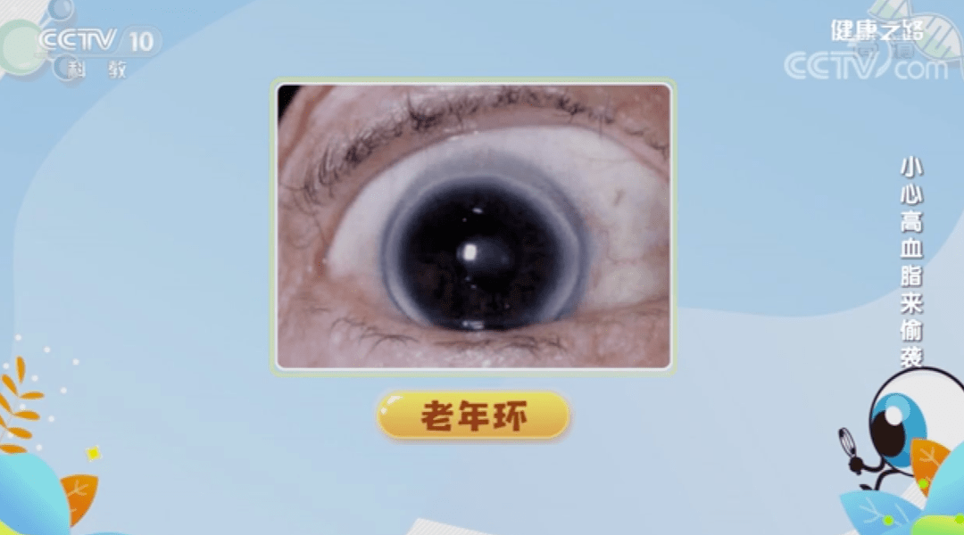 或橙色斑块,微微高出皮肤,上下眼睑都可出现,多见于40-60岁的中老年人