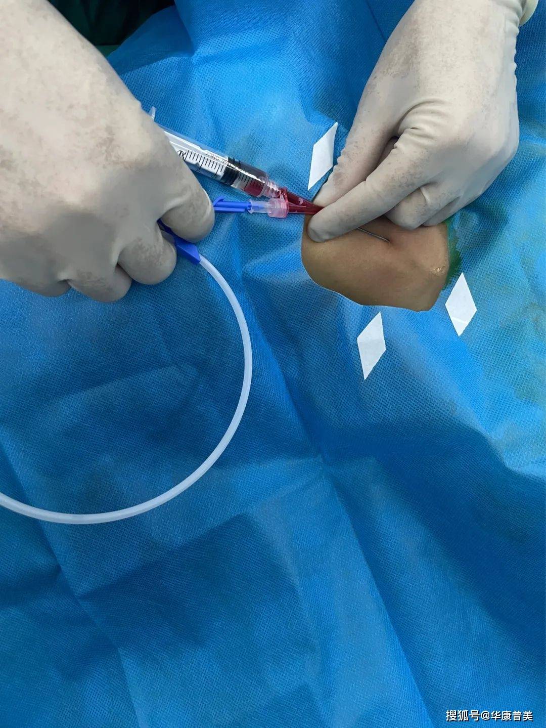股静脉穿刺置管术步骤图片