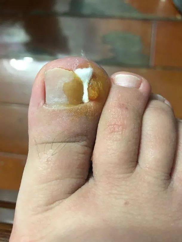 ▽【甲沟炎患者沟通群】欢迎加入可不是一个人然而抠出甲沟炎抠脚大汉
