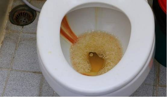 尿酸高的人,排尿时会出现3大"异常",做好这3事可护肾防痛风_补充_尿液