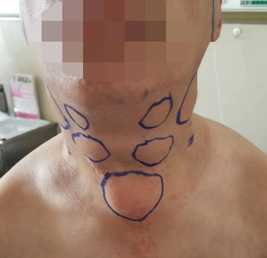 马德龙综合征 来自搜狐网