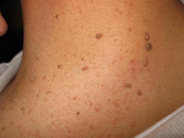 体内感染的病毒就会有以小肉粒的形式展现,感染病毒之后的小肉瘤存在