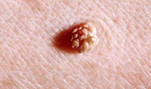 原创脖子和腋下的小肉粒是啥能用手扯下来吗早知早好