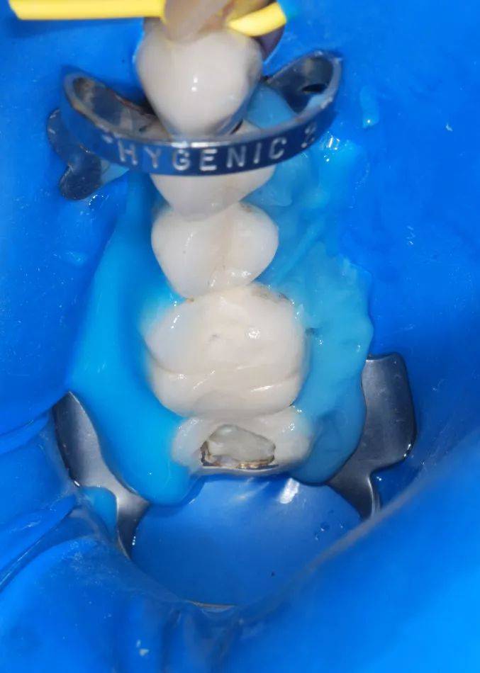 韩国五星橡皮障使用优点介绍_治疗_操作_口腔