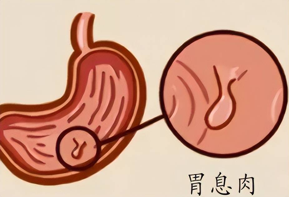 胃底腺息肉:胃底腺息肉是指发生于胃底部的胃息肉
