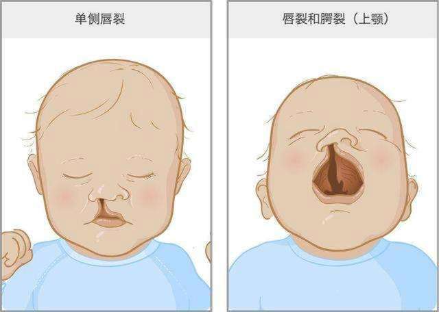 省钱没做产检,生出了兔唇宝宝,不治疗影响大吗?-搜狐大视野-搜狐新闻