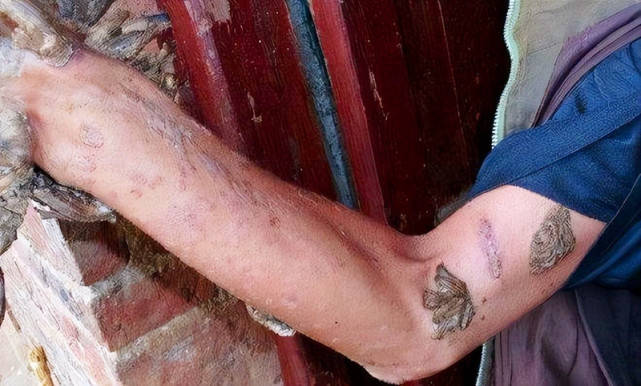 湖南男子手脚长树枝会开花父母乱投医拜树神20年后才弄清病因