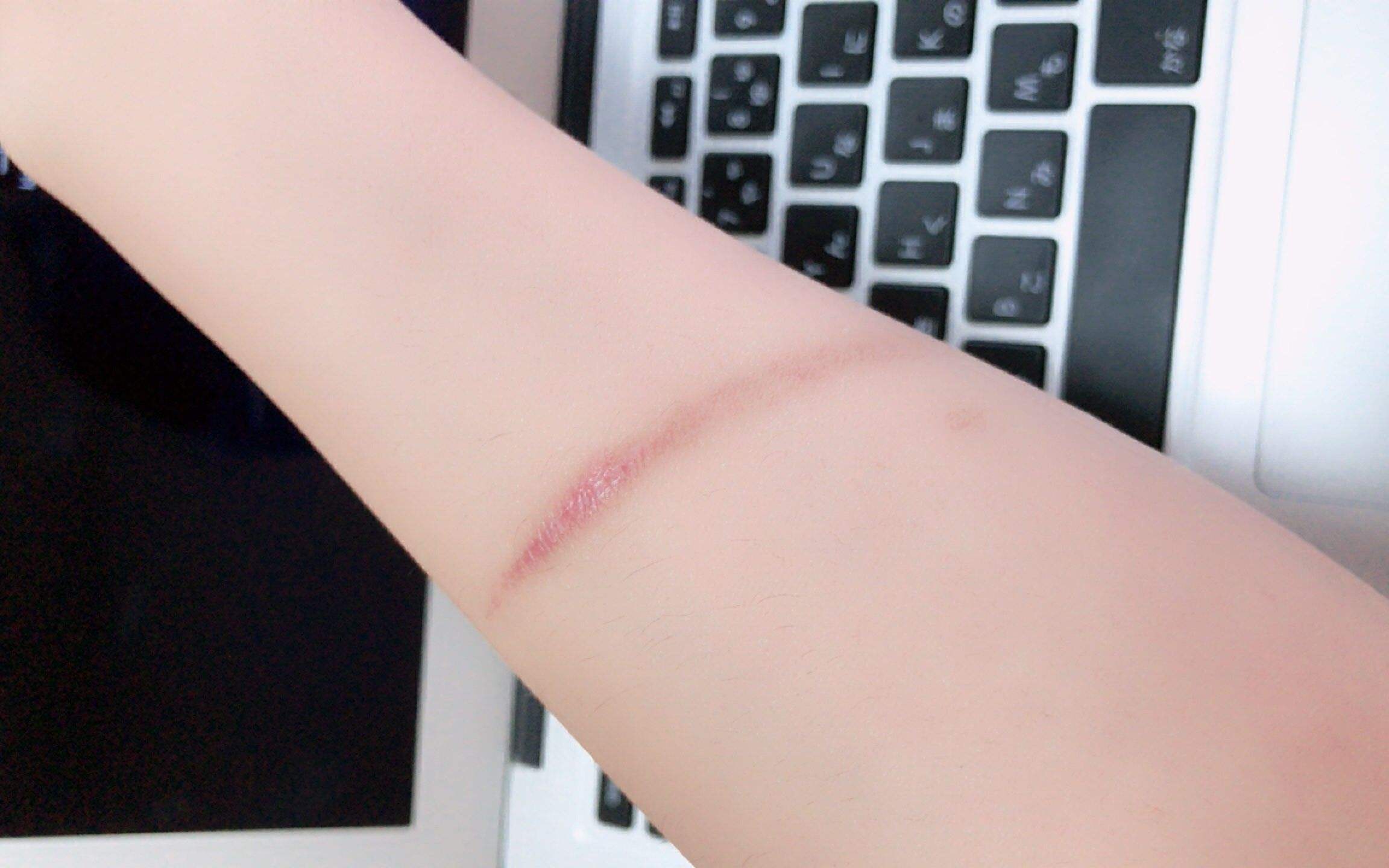 治疗_浅表性_萎缩性