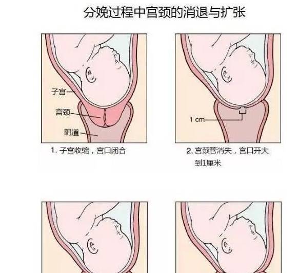 正常情況下,宮頸口張開約有一指尖的間隔.隨著產程的開始,子宮口逐漸