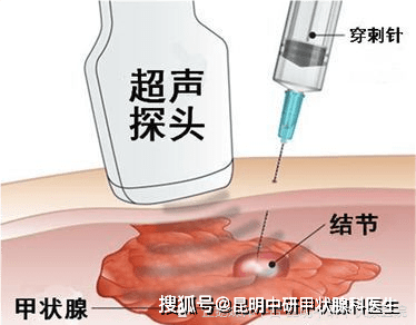 甲状腺穿刺怎么做图片