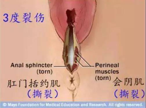 Ⅳ度裂伤:指肛门,直肠和阴道完全贯通,直肠肠腔外露,组织损伤严重