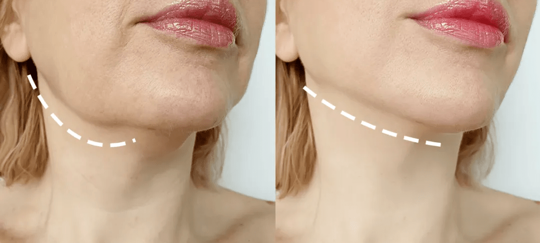 什么是"金字塔少女线"?