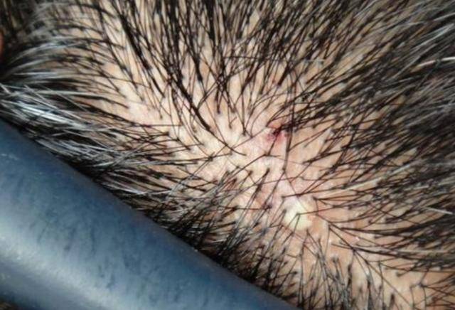 为什么头皮总长"疙瘩"和"脓包"?或许跟这4个因素有关