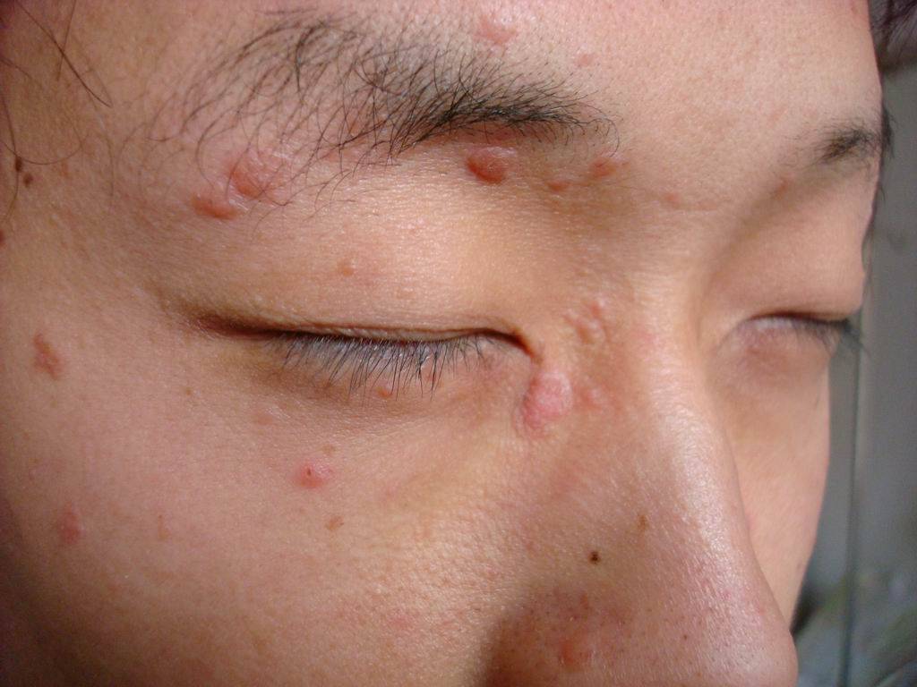 26岁男子脸上长满"肉粒",查出hpv感染,医生:怎么不早点检查_病毒_间接