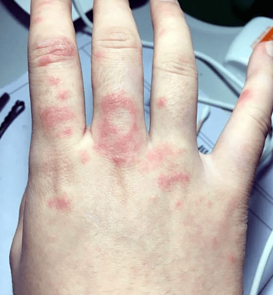 手上长疮了怎么办?农村小伙教你一招,不花一分钱三天就见效!