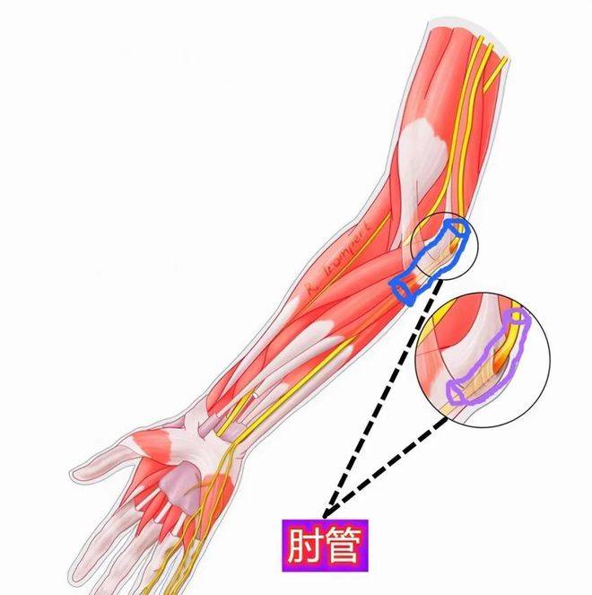 ②肘管综合症:多在有肘外翻的女性劳损时或外伤后骨折,关节炎压迫肘拐