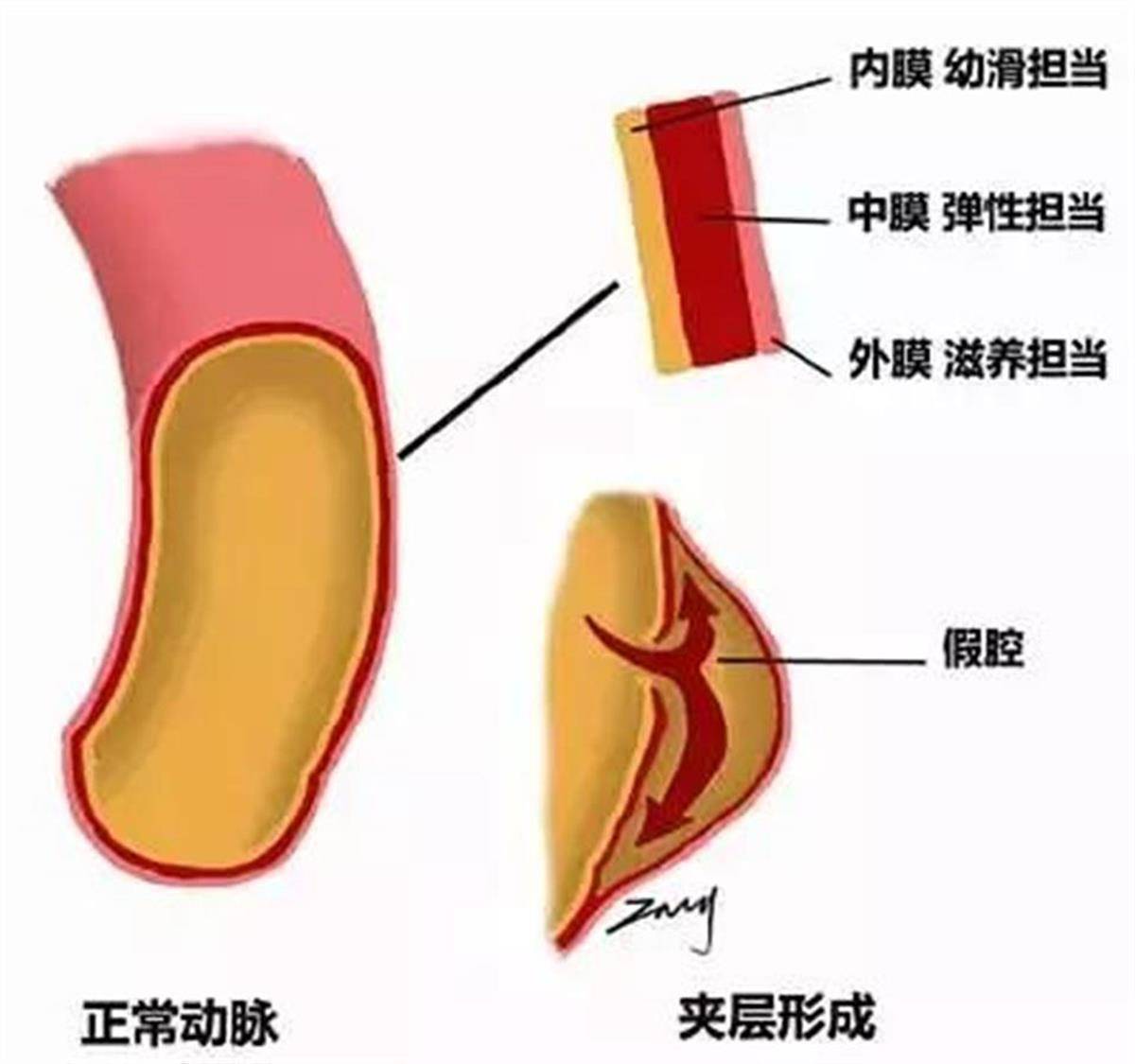 正常的人体动脉血管由3层结构组成,即内膜,中膜和外膜,3层结构紧密