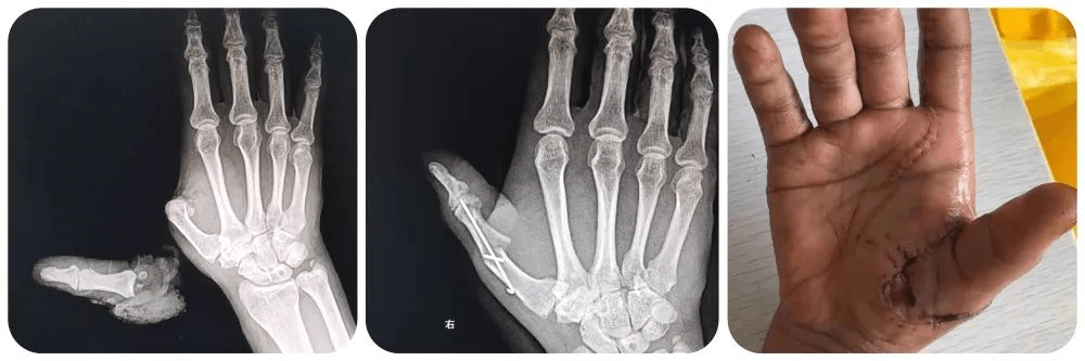 手指再造了解一下!_进行_功能_患者