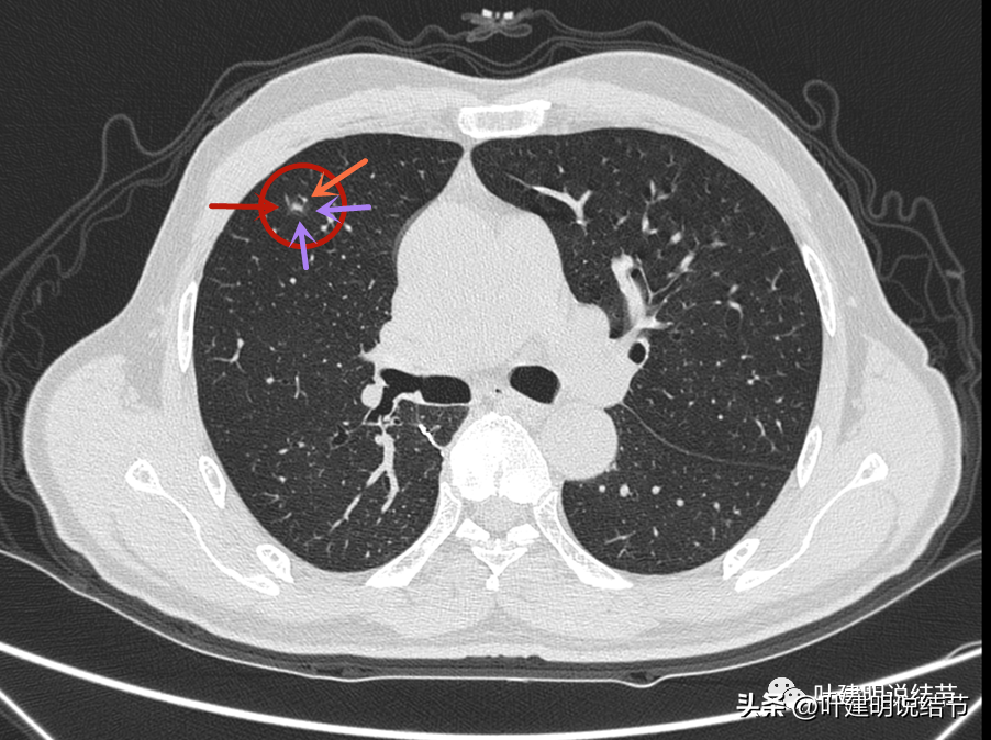 肺癌术后3年发现肺多发实性结节，我是如何准确判断不是转移的？