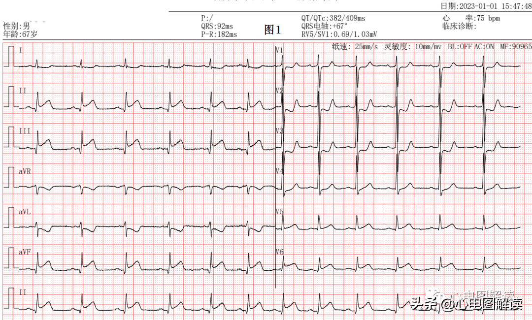 急性心包炎心电图表现图片