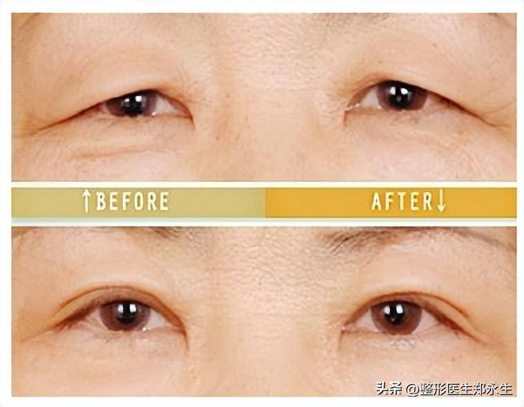 我们可以做的有:筋膜悬吊提眉手术上眼皮松弛耷拉,三角眼,眼皮臃肿(肿