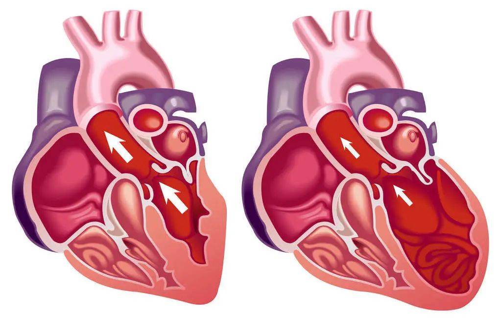 這5種有遺傳性的心臟病,建議您快來檢查_患者_父母_基因