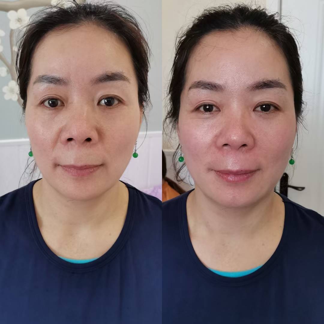 鼻子假体填充微整形有哪几种方法?效果哪家专业?排名 怎么收费?