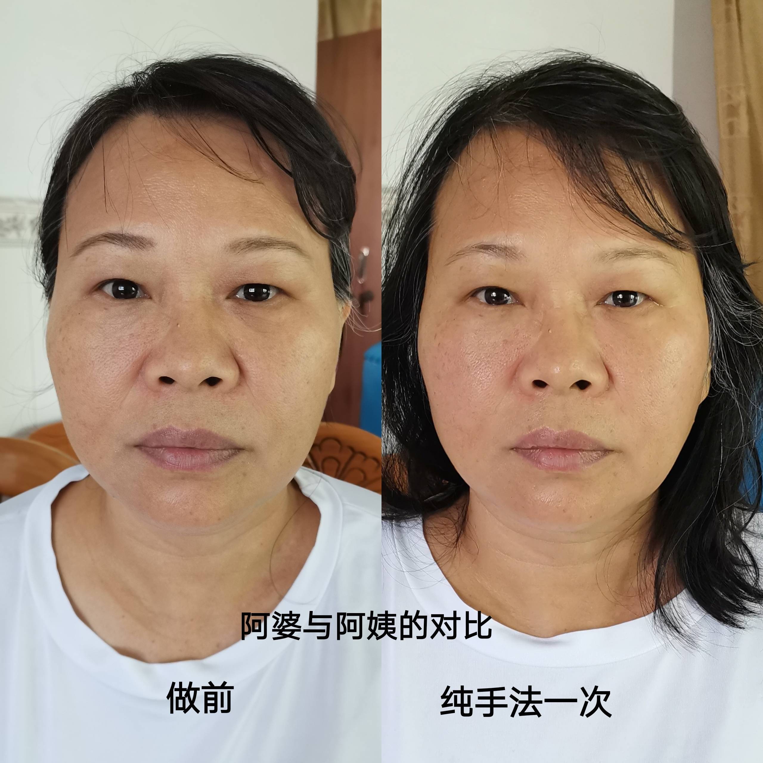 鼻子假体填充微整形有哪几种方法?效果哪家专业?排名 怎么收费?