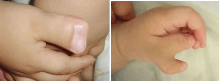 谈医论症|"六指琴童"手护战,你做对了吗?