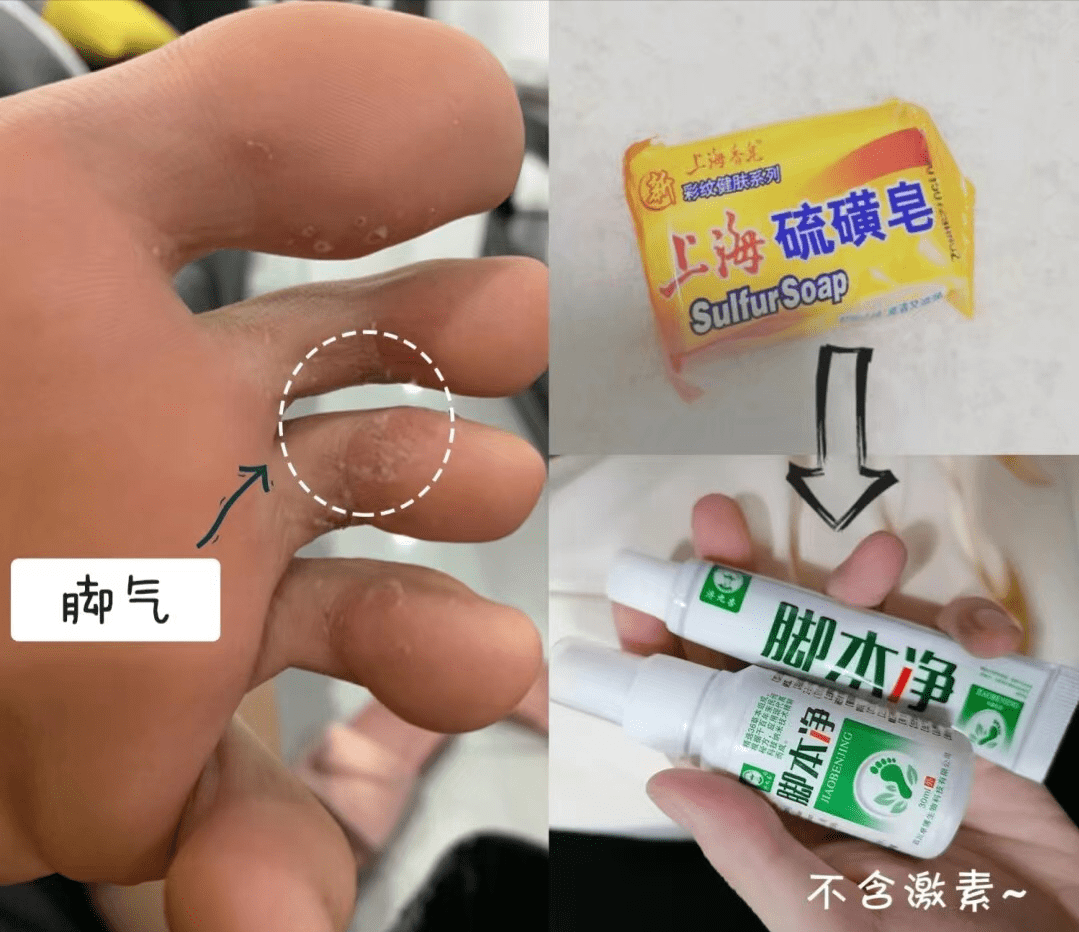 對於水泡型腳氣,糜爛性腳氣都有效果,洗完之後搭配上腳氣膏一起使用