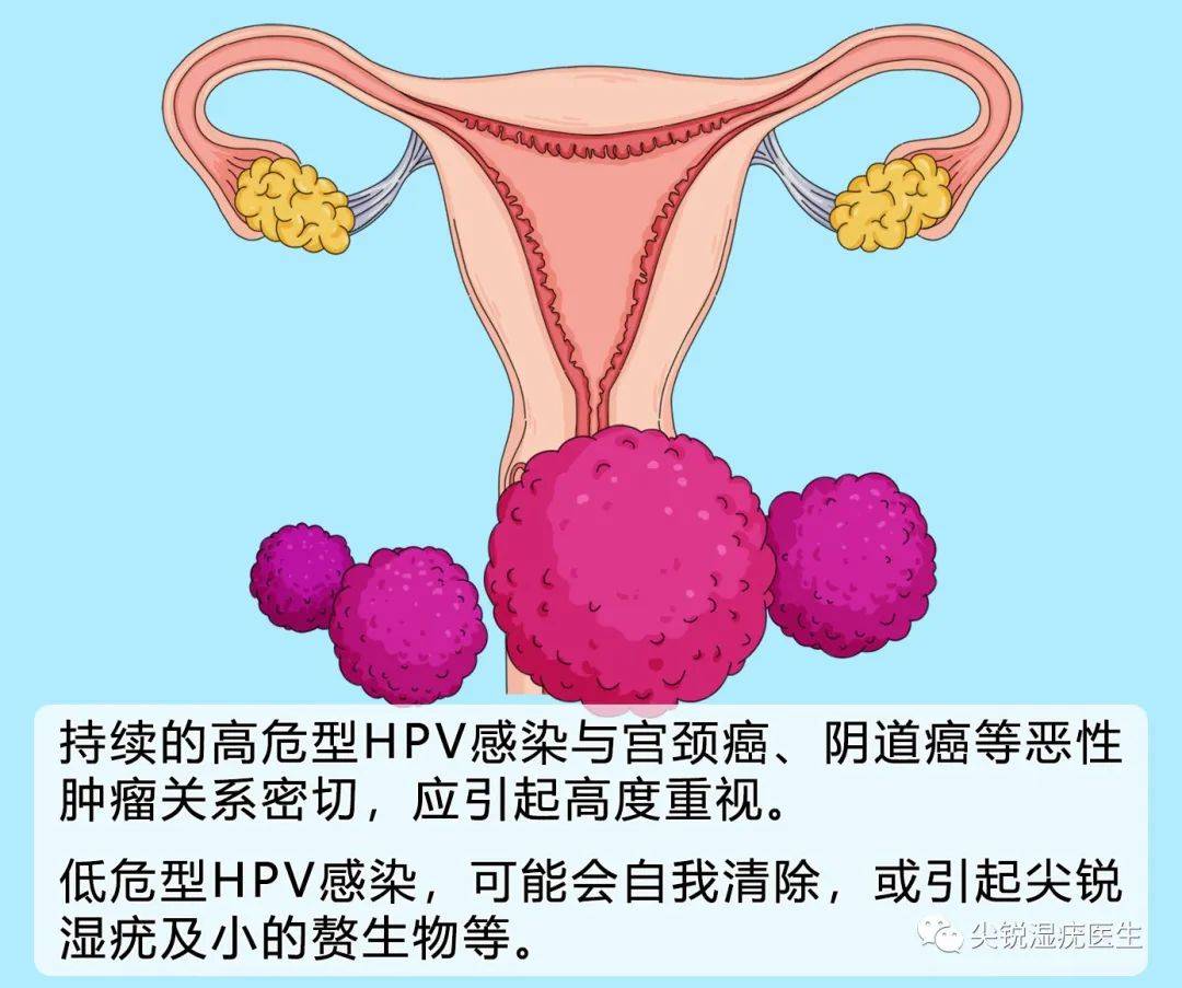 检查出宫颈hpv阳性是什么意思怎么办