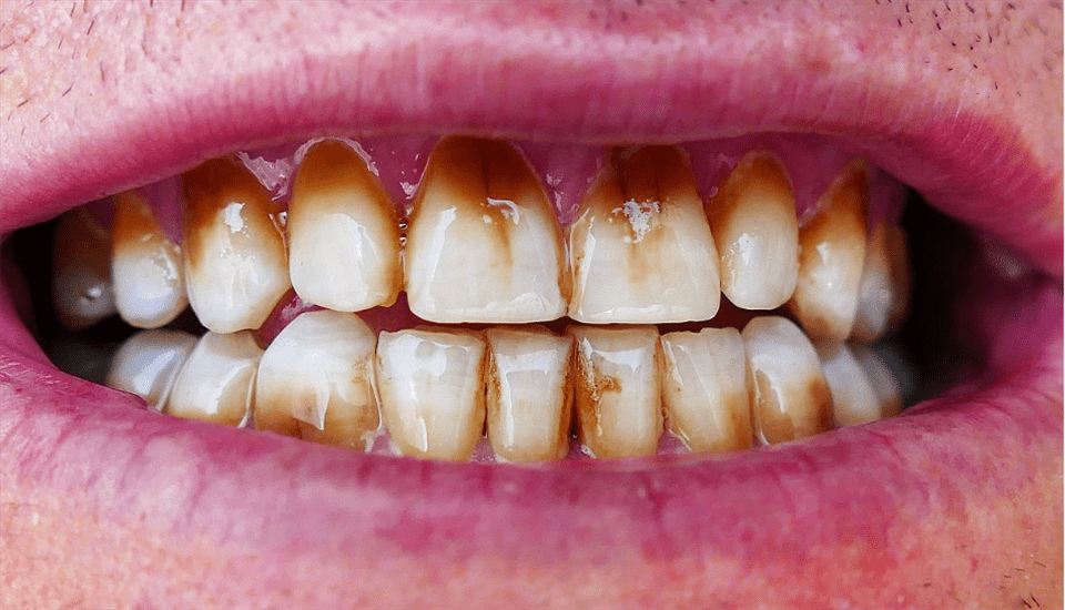 烟渍滋生!牙齿又黑又臭,过来人教你3招!黄牙秒变白牙不反复!