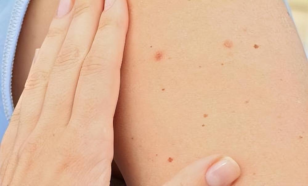 皮肤上莫名出现小红点,还不痛不痒,到底是什么?