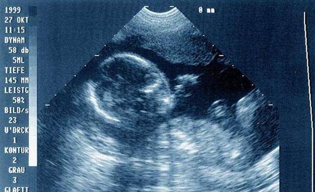 怀孕三个月男宝b超图图片