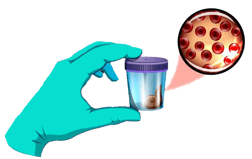 大便隐血(又称便隐血,英文为fob(fecal occult blood))是指消化道少量